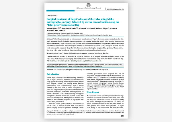 Surgical treatment of Paget’s disease of the vulva using Mohs micrographic surgery.