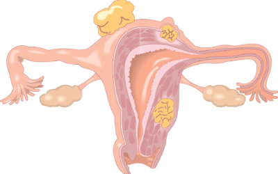 Ovarian Cancer in Spain