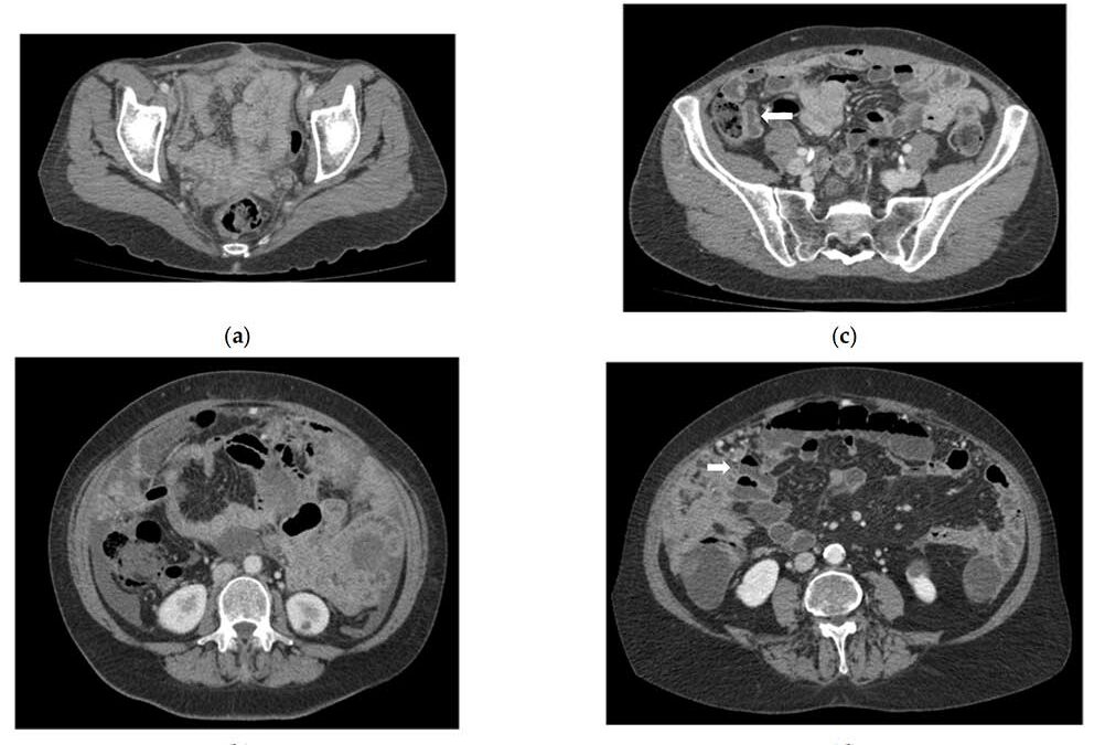 CT Enterography for Preoperative Evaluation of Peritoneal Carcinomatosis Index in Advanced Ovarian Cancer