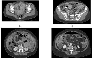 CT Enterography for Preoperative Evaluation of Peritoneal Carcinomatosis Index in Advanced Ovarian Cancer